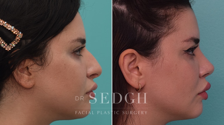 Rhinoplasty Before and After | Sedgh