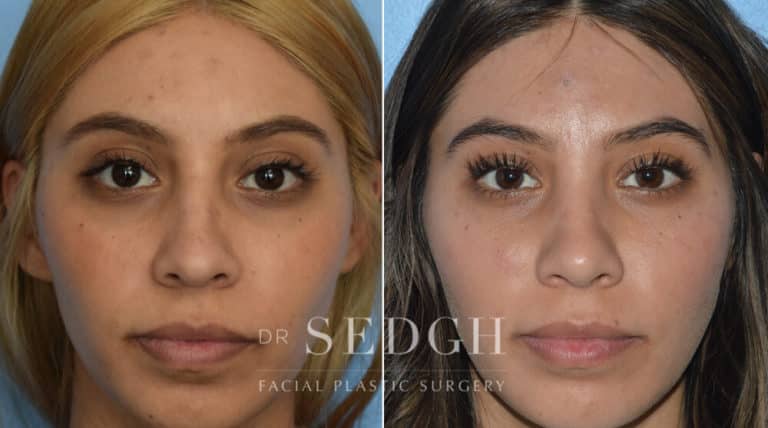 Rhinoplasty Before and After | Sedgh