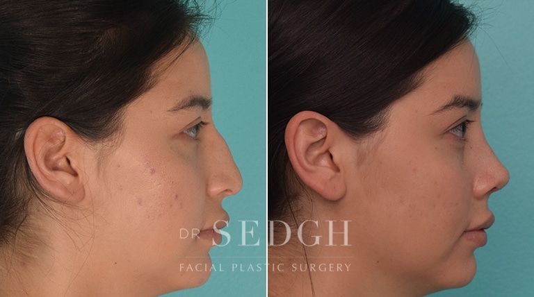 Rhinoplasty Before and After | Sedgh