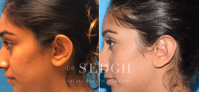 Pin Ears Back Ear Pinning Surgery Before and After Photos | Dr. Sedgh