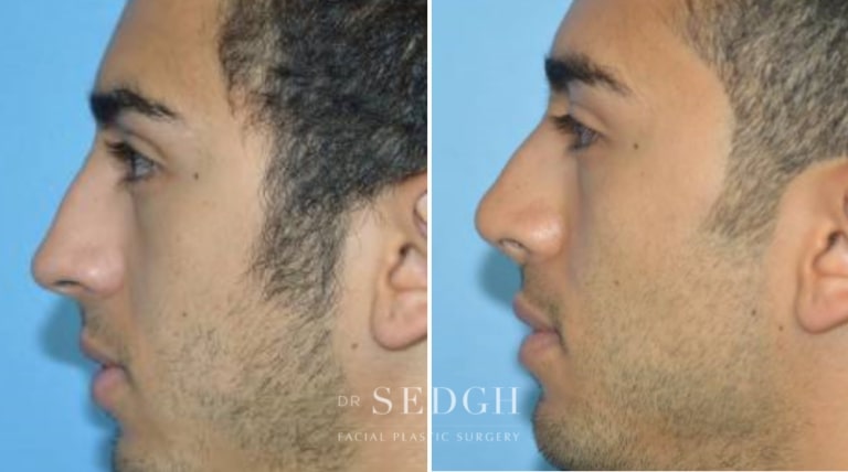 Rhinoplasty Before and After | Sedgh