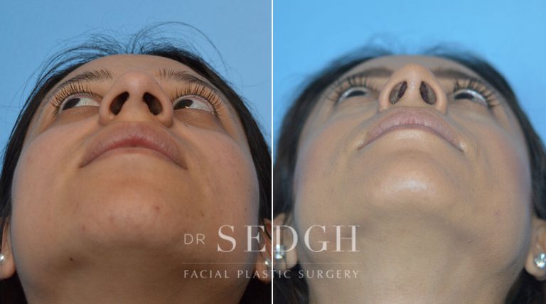 Rhinoplasty Before and After | Sedgh