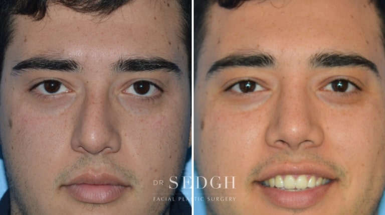 Rhinoplasty Before and After | Sedgh