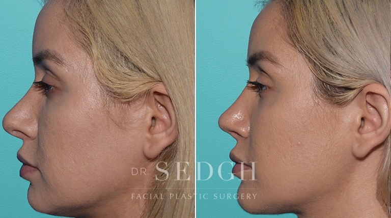 Revision Rhinoplasty Before and After | Sedgh