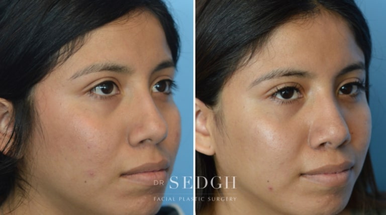 Rhinoplasty Before and After | Sedgh