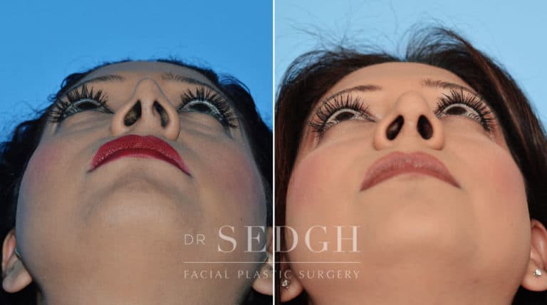 Nasal Fracture Before and After | Sedgh