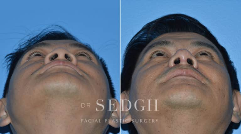 Rhinoplasty Before and After | Sedgh