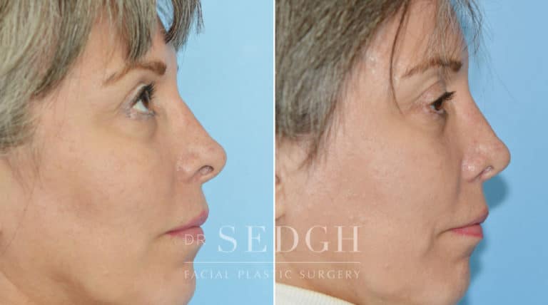 Revision Rhinoplasty Before and After | Sedgh