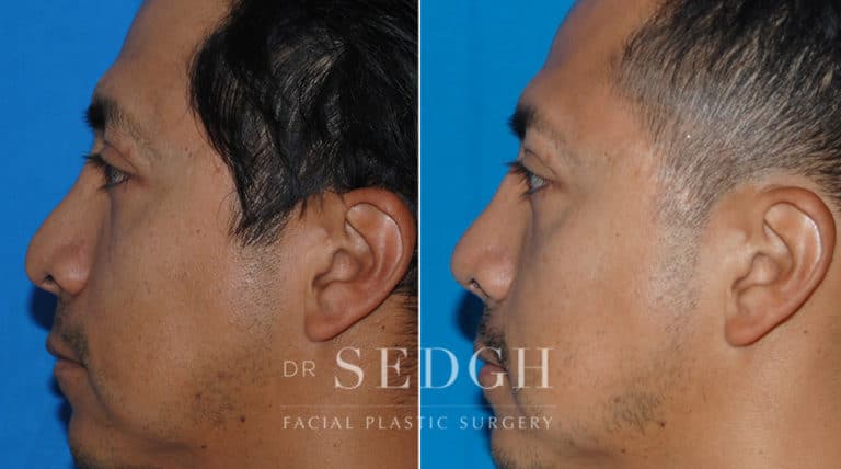 Revision Rhinoplasty Before and After | Sedgh