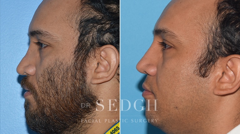 Rhinoplasty Before and After | Sedgh