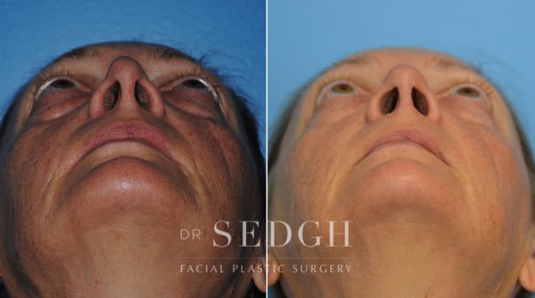 Revision Rhinoplasty Before and After | Sedgh