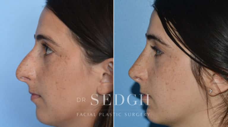 Rhinoplasty Before and After | Sedgh