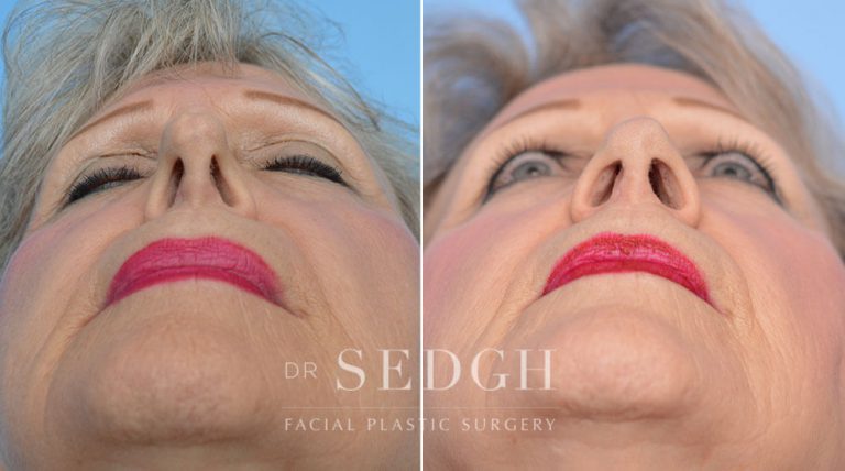 Revision Rhinoplasty Before and After | Sedgh