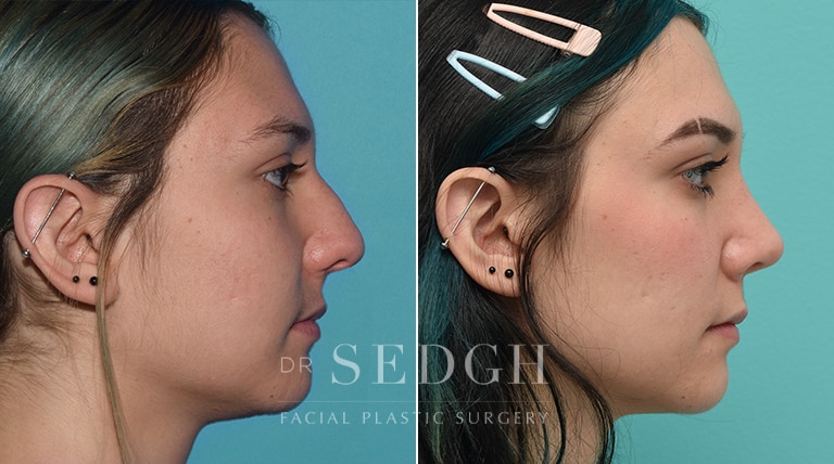 Rhinoplasty Before and After | Sedgh