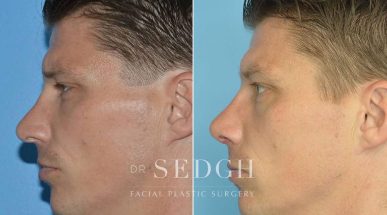 Rhinoplasty Before and After | Sedgh