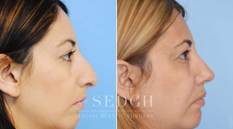 Rhinoplasty Before and After | Sedgh