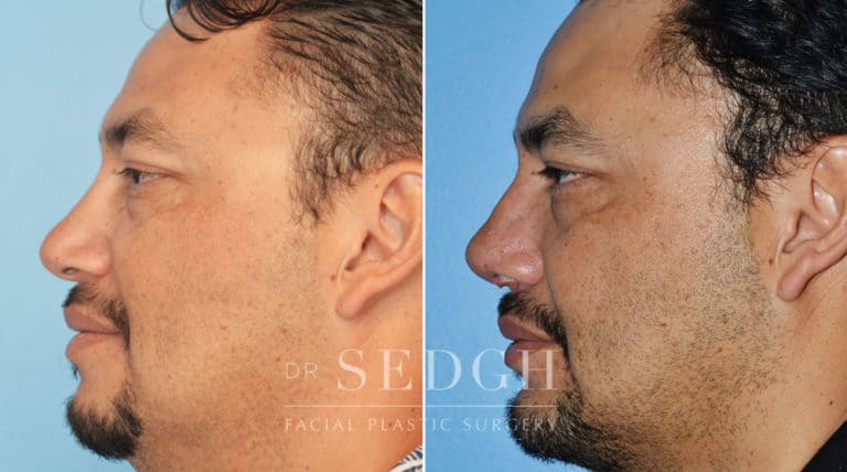 Revision Rhinoplasty Before and After | Sedgh