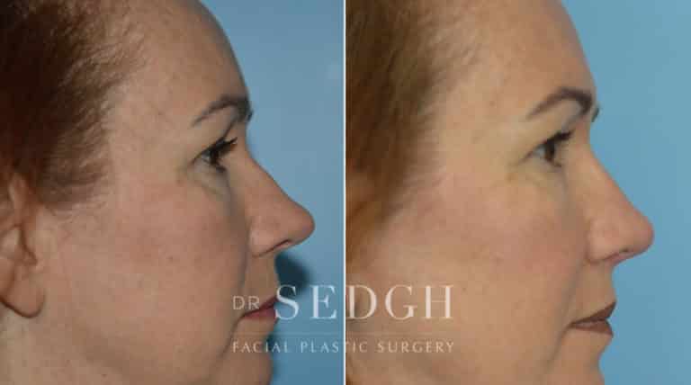 Rhinoplasty Before and After | Sedgh