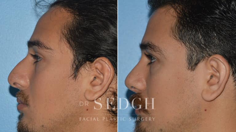 Rhinoplasty Before and After | Sedgh