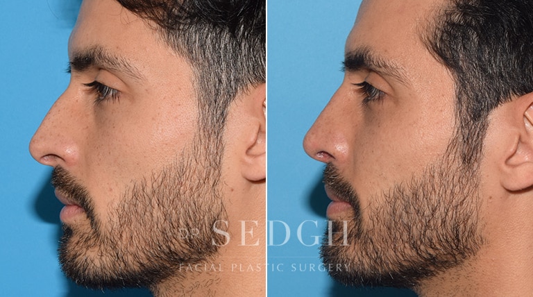 Rhinoplasty Before and After | Sedgh