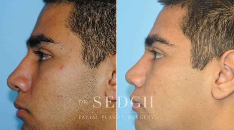 Crooked Nose Surgery Before and After | Sedgh