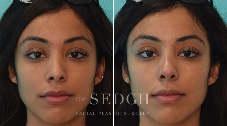 Facial Fillers Before and After | Sedgh