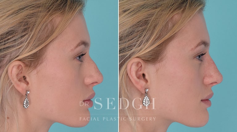 Facial Fillers Before and After | Sedgh