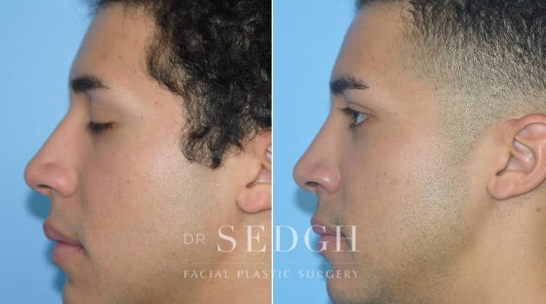 Crooked Nose Surgery Before and After | Sedgh