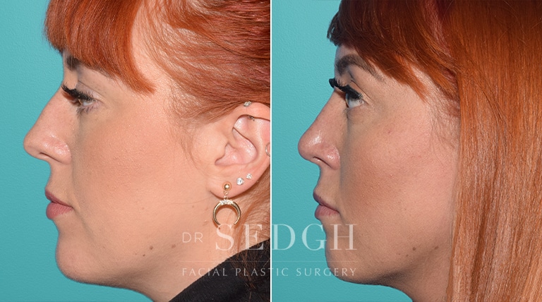 Facial Fillers Before and After | Sedgh