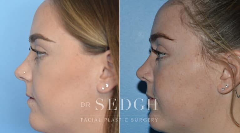 Crooked Nose Surgery Before and After | Sedgh