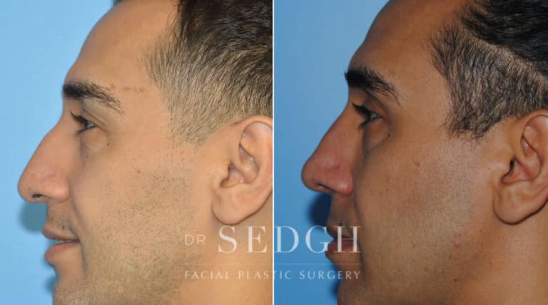 Rhinoplasty Before and After | Sedgh