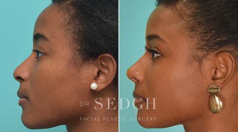 Rhinoplasty Before and After | Sedgh