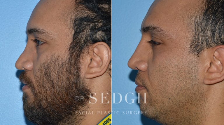 Crooked Nose Surgery Before and After | Sedgh