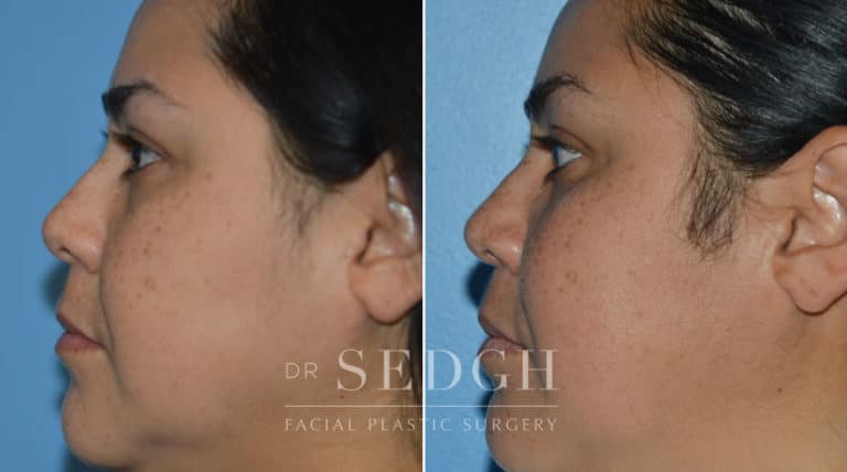 Crooked Nose Surgery Before and After | Sedgh