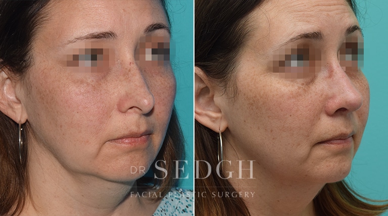 Female Rhinoplasty Before and After | Sedgh