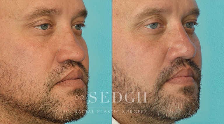 Rhinoplasty Before and After | Sedgh