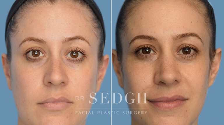 Rhinoplasty Before and After | Sedgh