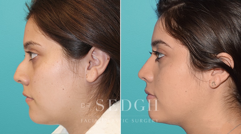 Female Rhinoplasty Before and After | Sedgh