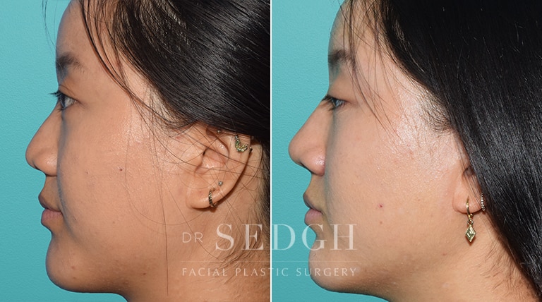 Female Rhinoplasty Before and After | Sedgh