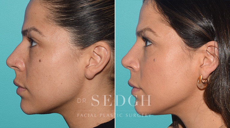 Female Rhinoplasty Before and After | Sedgh