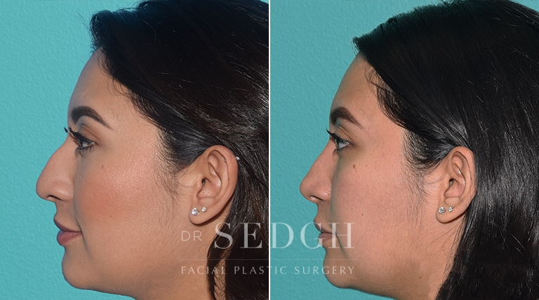 Female Rhinoplasty Before and After | Sedgh