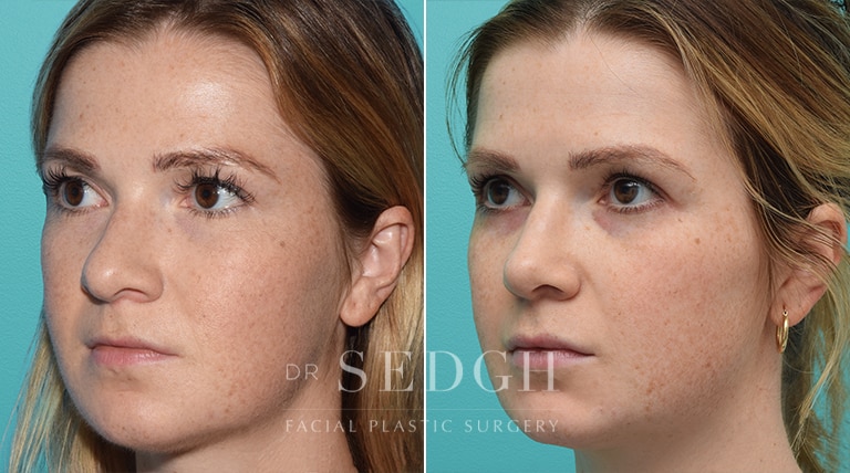 Female Rhinoplasty Before and After | Sedgh