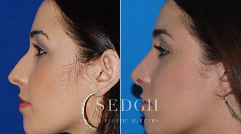 Female Rhinoplasty Before and After | Sedgh