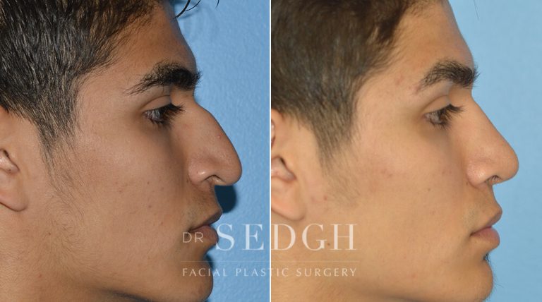 Rhinoplasty Before and After | Sedgh