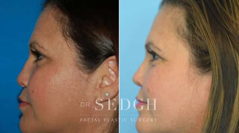 Female Rhinoplasty Before and After | Sedgh