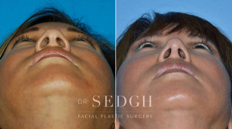 Female Rhinoplasty Before and After | Sedgh