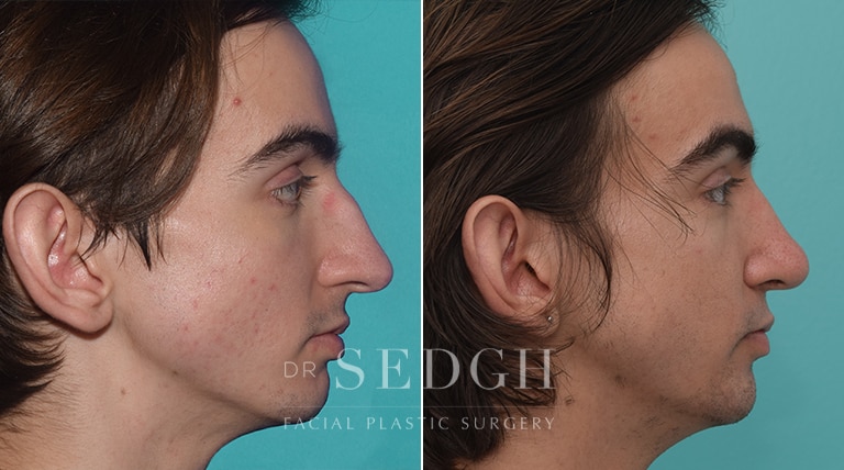 Male Rhinoplasty Before and After | Sedgh