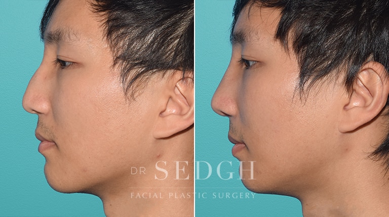 Male Rhinoplasty Before and After | Sedgh