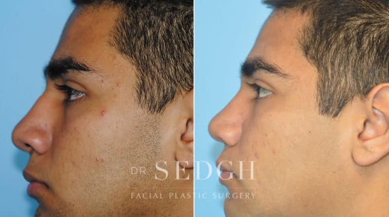 Latino Rhinoplasty Before and After | Sedgh