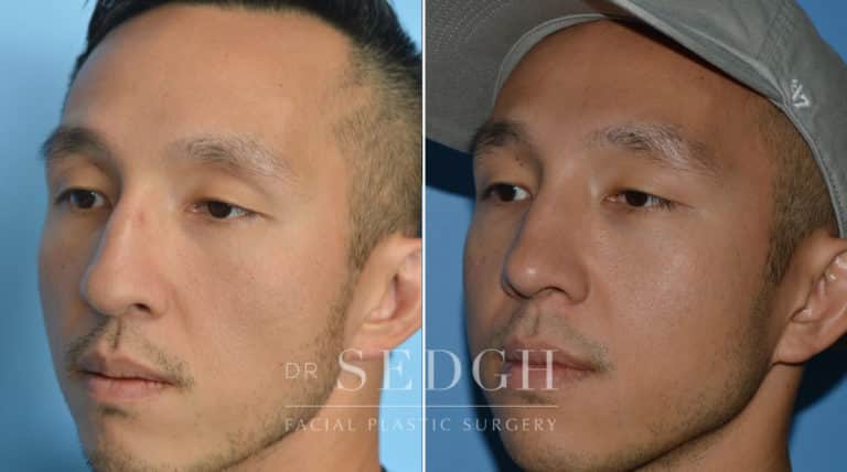 Asian Rhinoplasty Before and After | Sedgh